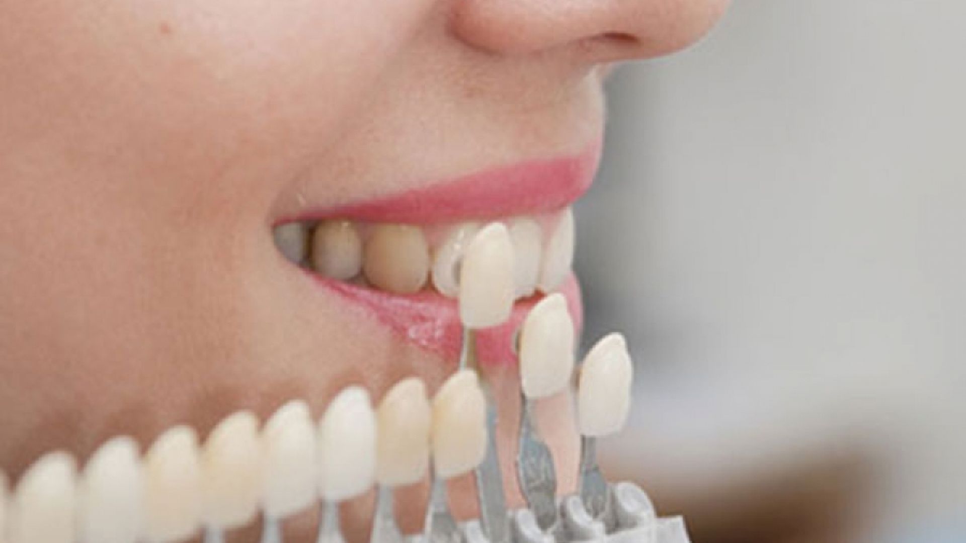 Teeth color shade samples