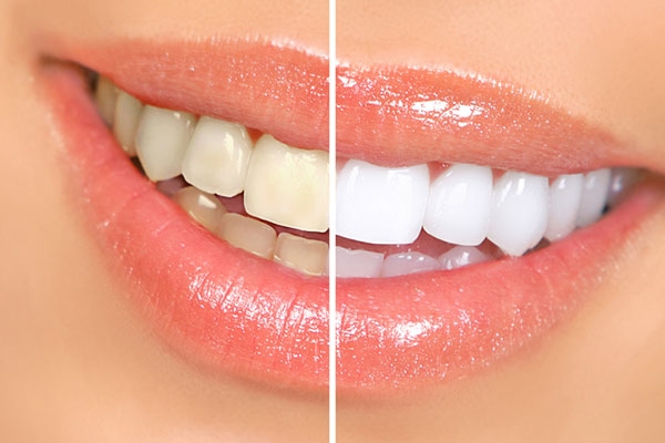 Brighten Your Smile with Zoom Teeth Whitening