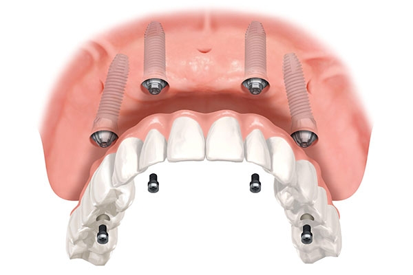 All-on-4 Dental Implants: New Teeth in One Day